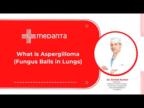  What is Aspergilloma (Fungus Balls in Lungs)? 